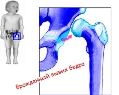 Файл:Congenital dislocation of the hip.jpg