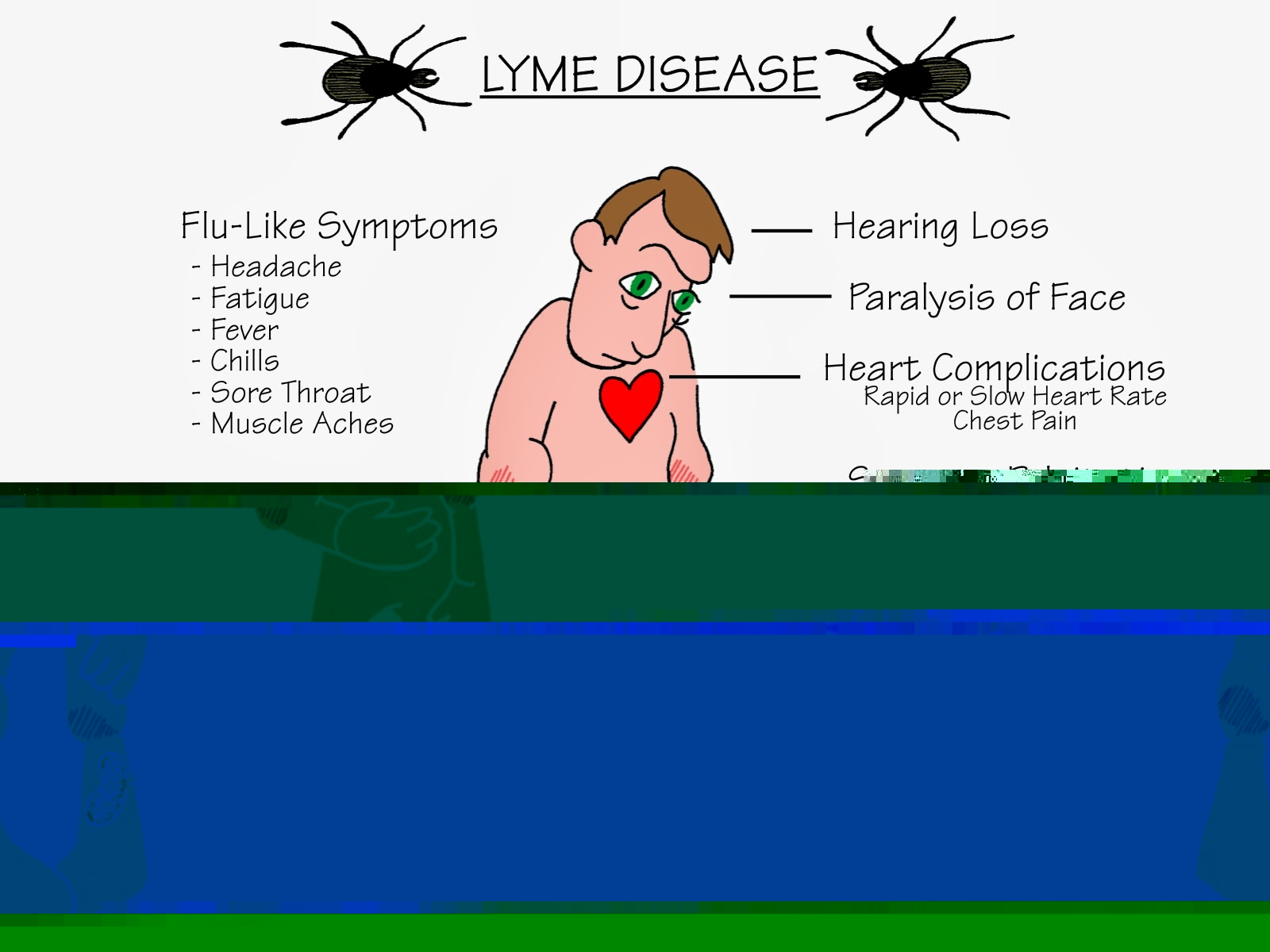 Файл:Lyme-Disease.jpg