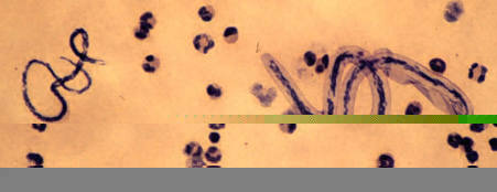 Файл:Filariasis Microfilariae of Loa loa (right) and Mansonella perstans (left) DPDx.JPG